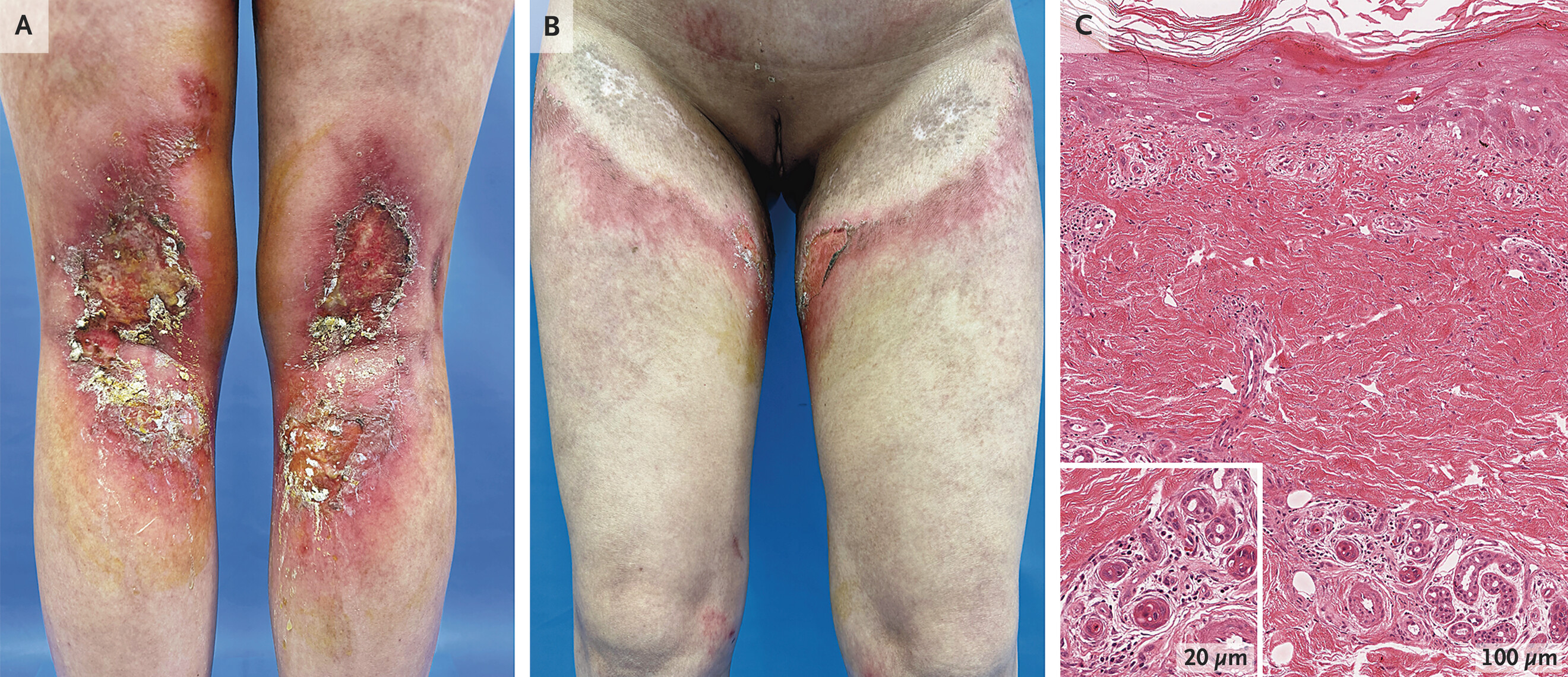 Toxic Erythema of Chemotherapy